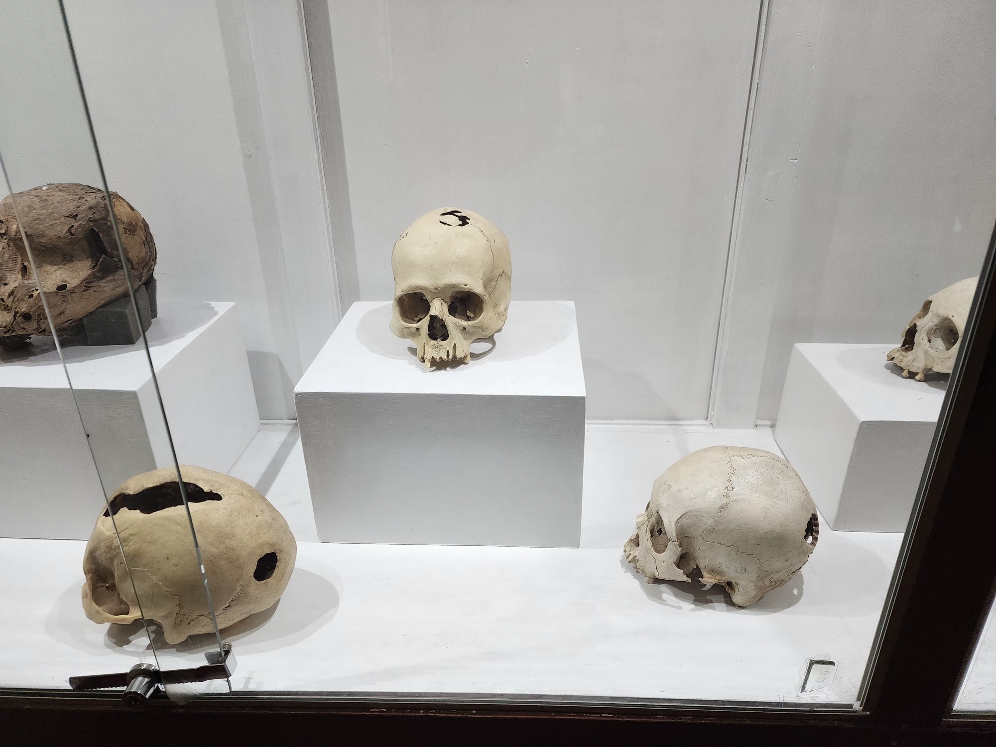 Inca trephinated skull on display